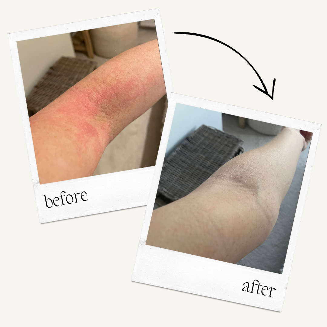 Beef tallow eczema before and after