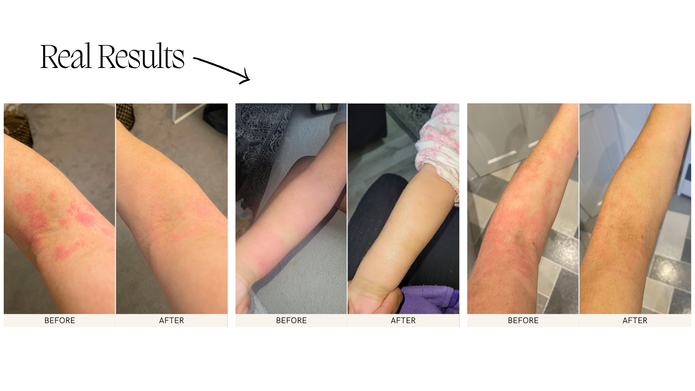 Beef tallow for eczema before and after