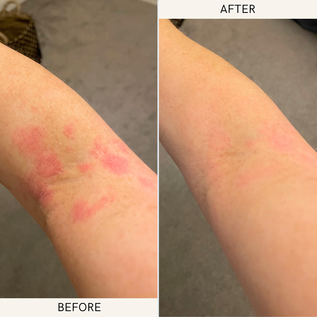 Eczema flare on arm before and after